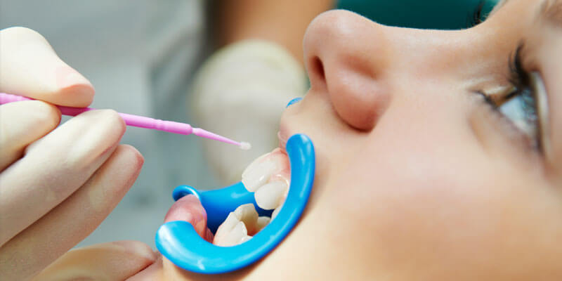 Dental-Sealants - Kent Dentist