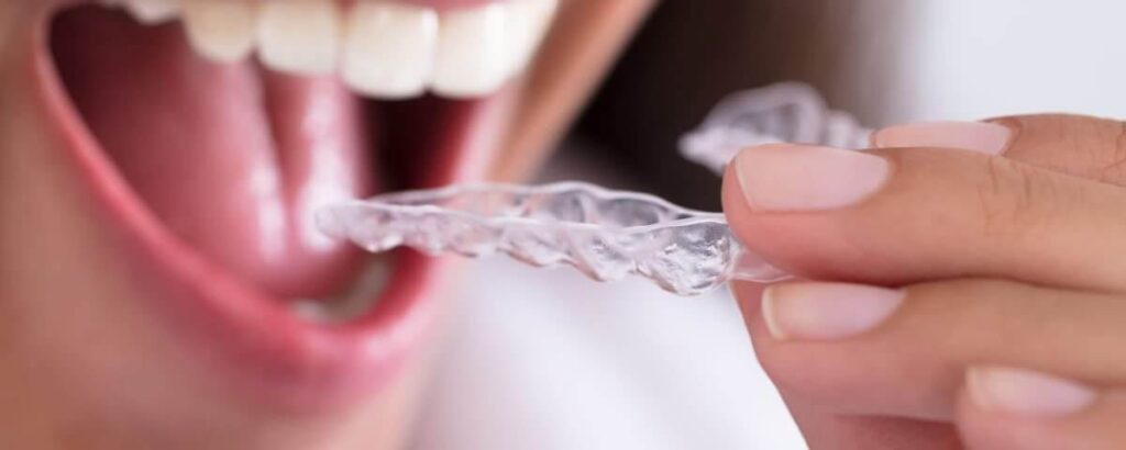 Invisalign 2 Mouthguard - Kent Dentist