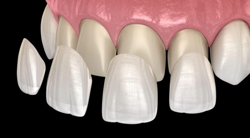 Crowns & Veneers - Kent Dentist