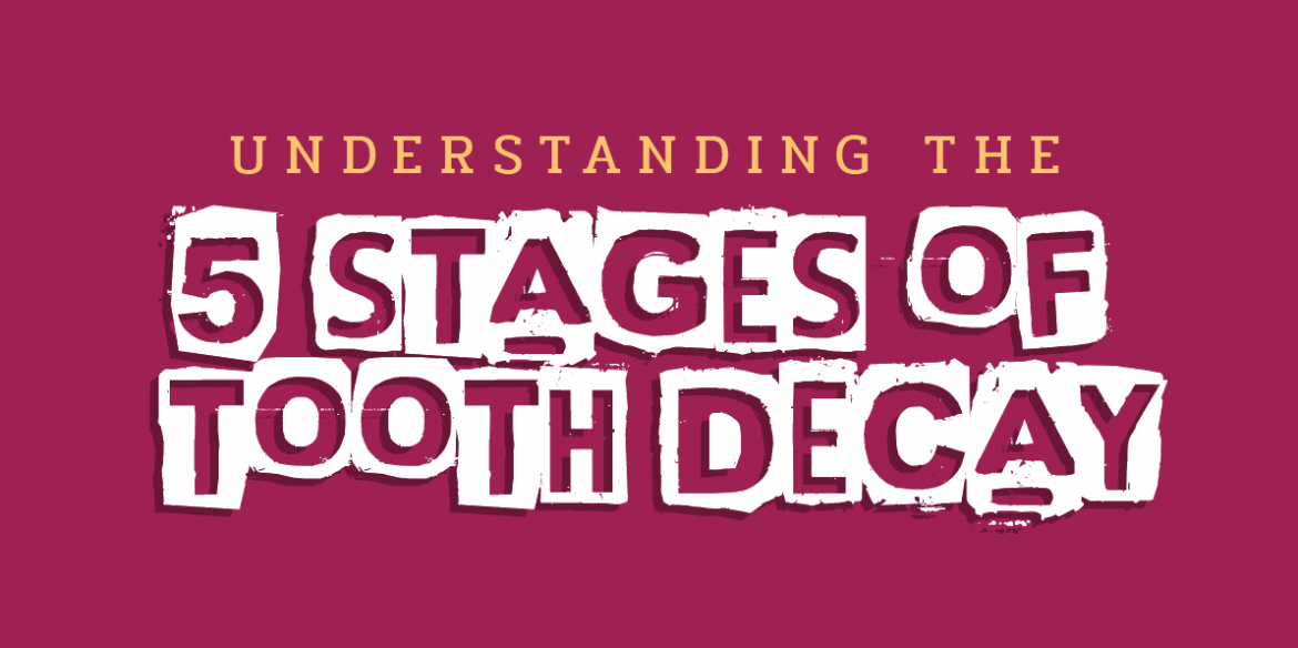 5-stages-of-tooth-decay - Kent Dentist