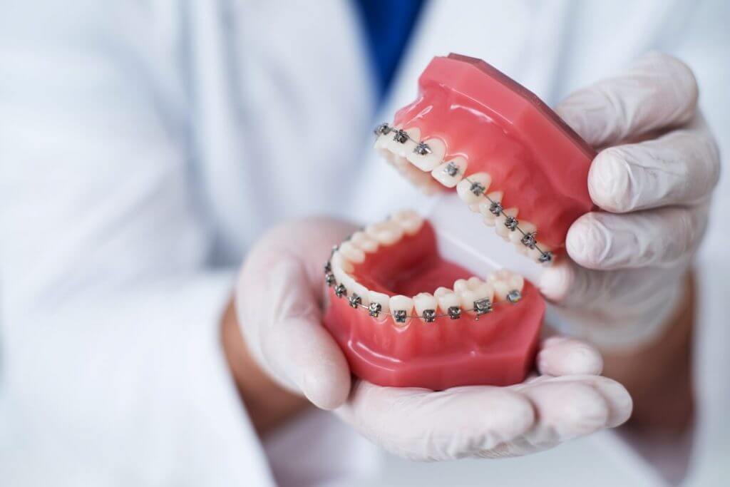 Invisalign Treatment Process - Kent Dentist