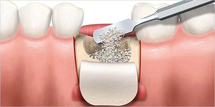 Bone Graft - Kent Dentist