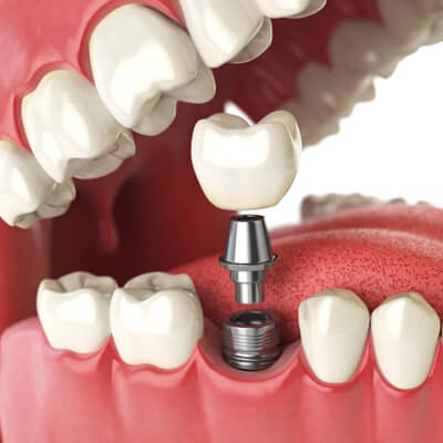 implant restoration - Kent Dentist
