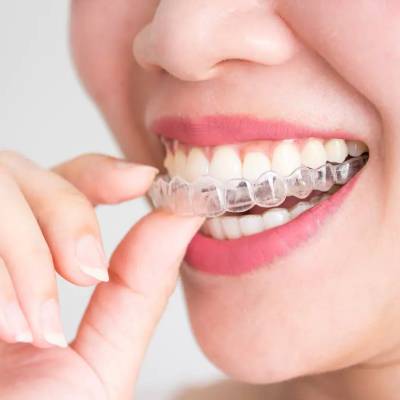 Clear Correct Braces- Kent Dentist