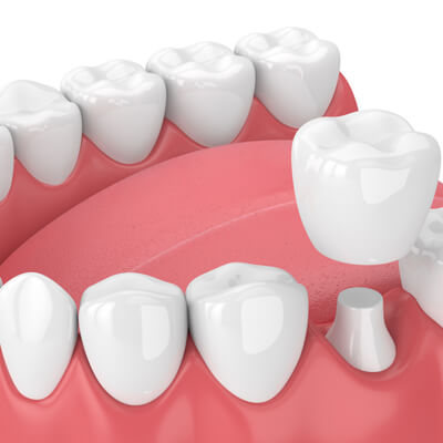 Dental Crowns & Bridges - Kent Dentist