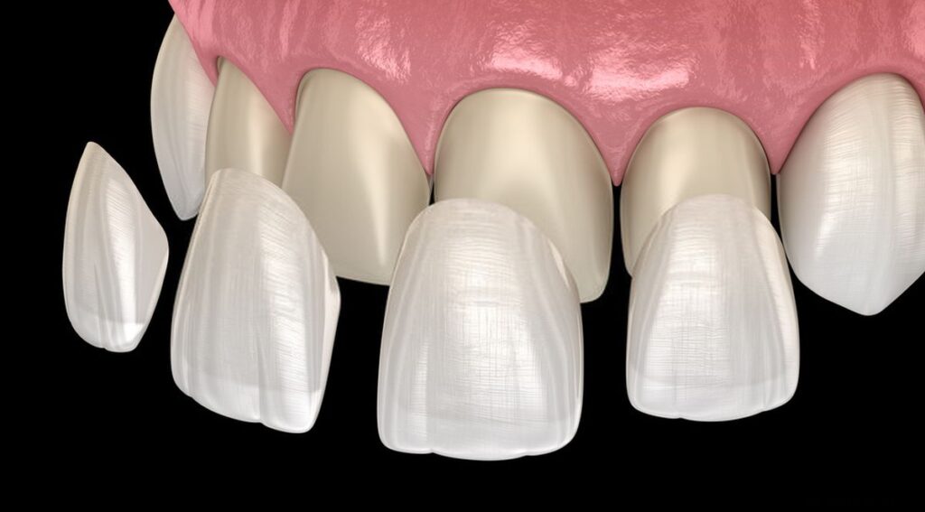 Dental Veneers - Kent Dentist