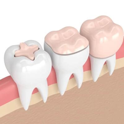 Inlay & Onlay - Kent Dentist