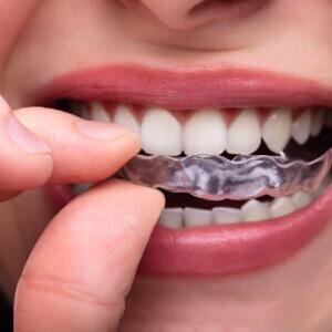 Invisalign Treatment - Kent Dentist