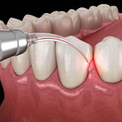 Periodontal (Gum Disease) Treatment - Kent Dentist