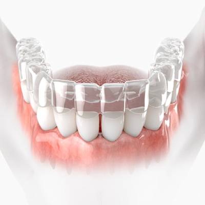 Sure Smile Aligners - Kent Dentist