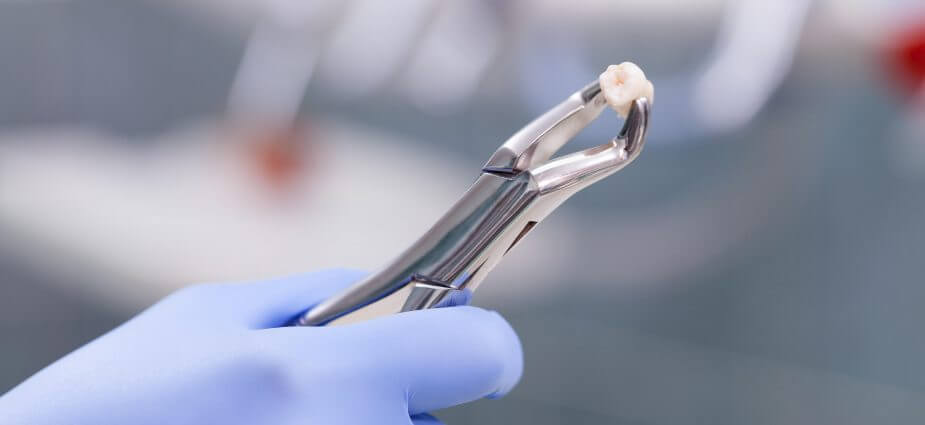 Tooth Extractions 1 Tooth-Extraction - Kent Dentist