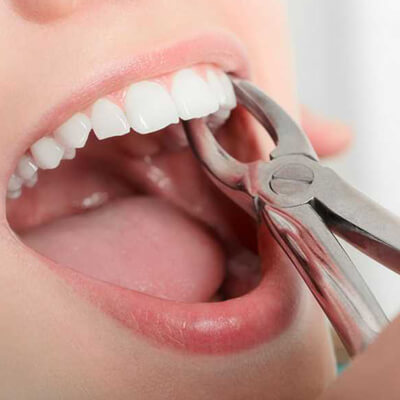 Tooth Extractions - Kent Dentist