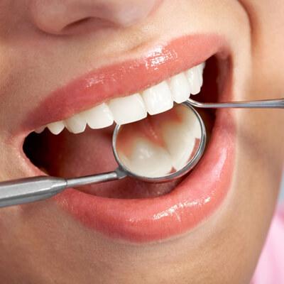 Tooth Fillings - Kent Dentist