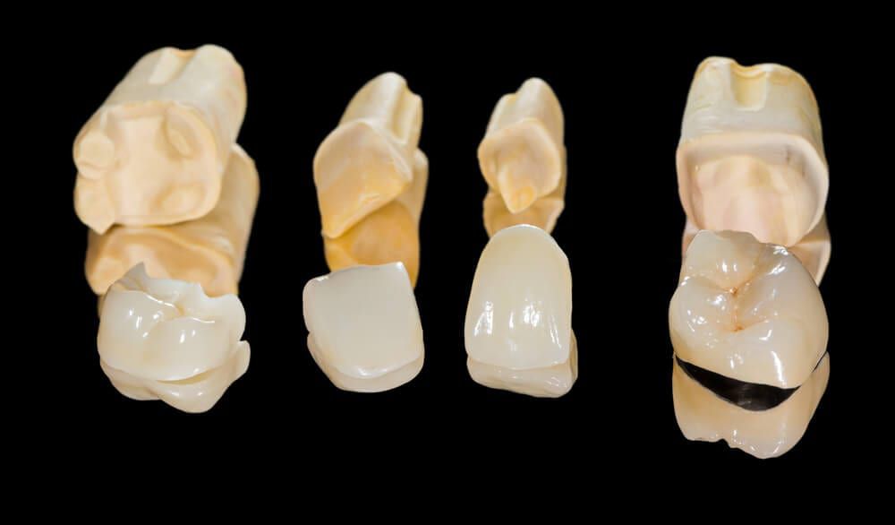 provisional-restorations - Kent Dentist