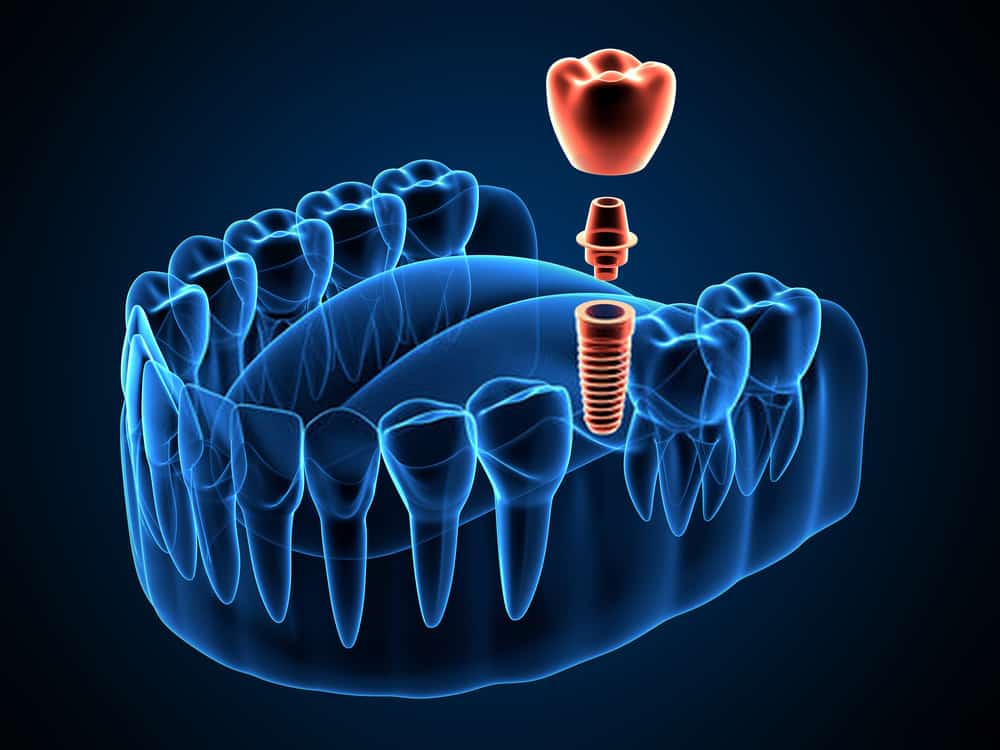 Dental Implant 1 tooth implant - Kent Dentist