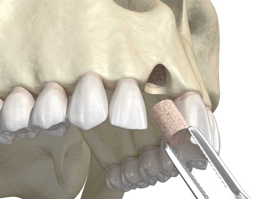 bone graft- Kent Dentist