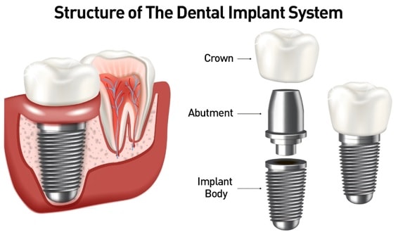 dental implant system - Kent Dentist